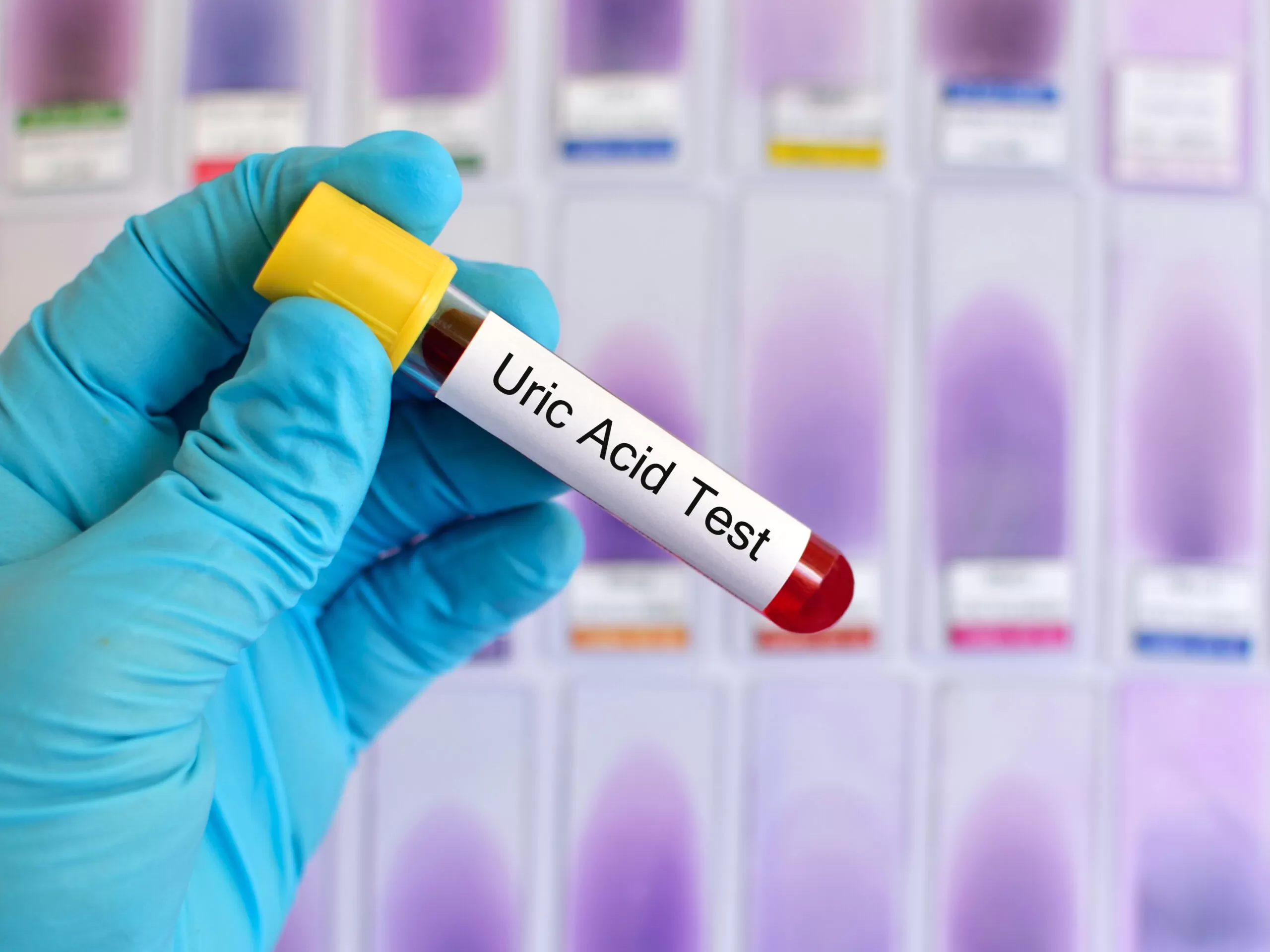 Acidul uric pe înțelesul tuturor – Ce este, cum poate fi testat și de ce este importantă determinarea nivelului acestuia?