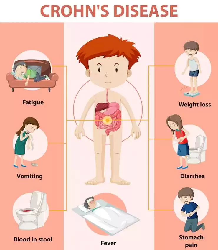 2. Boala Crohn simptome - Care sunt cele mai frecvente simptome ale bolii Crohn_Exemple de simptome in boala Crohn