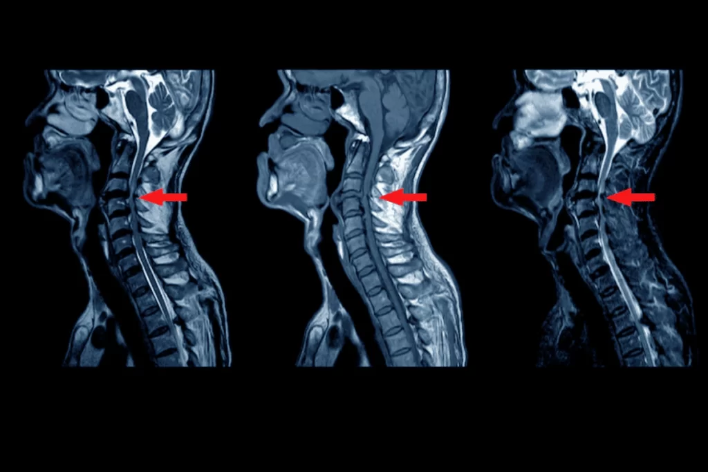 2. Care sunt cauzele spondilozei cervicale