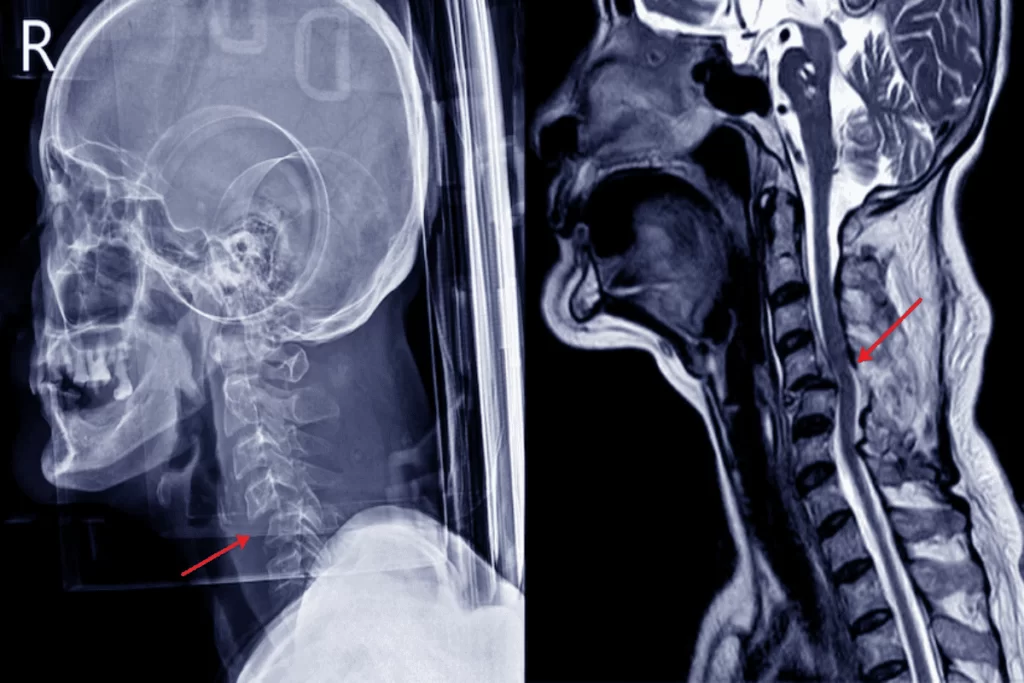 4. Cu ce tratez spondiloza cervicală