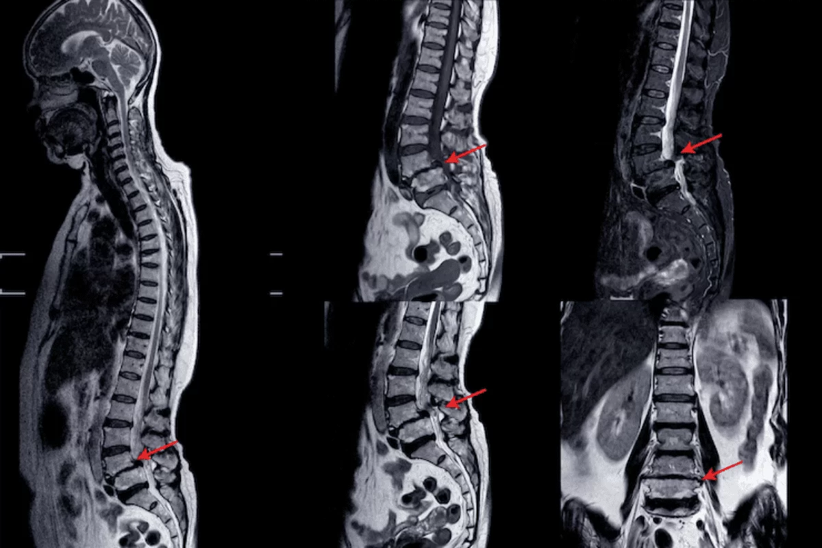 Spondiloza cervicală – ce trebuie să știi despre această degenerare a oaselor